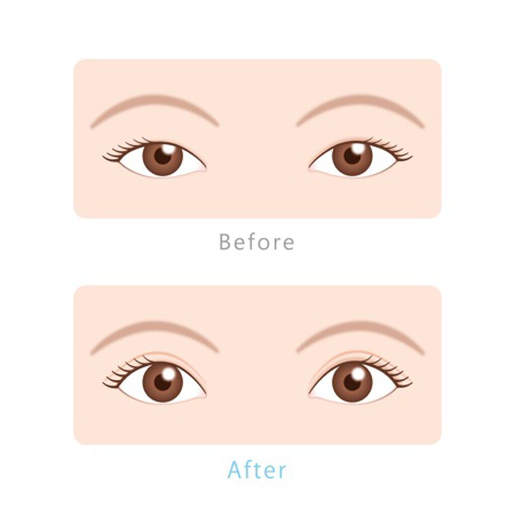 ゆき on LIPS 「こんにちは!今回は、私の二重にする方法を紹介します!私は、元々..」(1枚目)