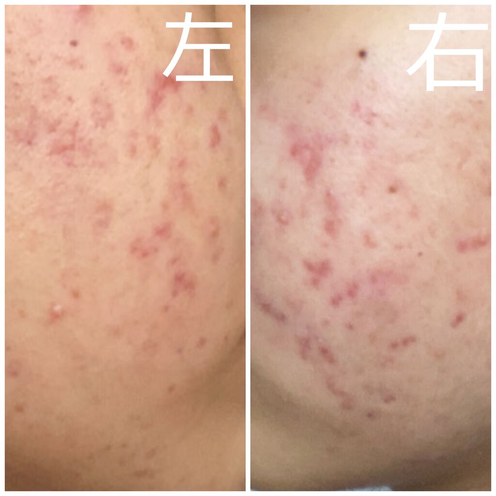 ロゼット洗顔パスタ アクネクリア/ロゼット/洗顔フォームを使ったクチコミ(1枚目)