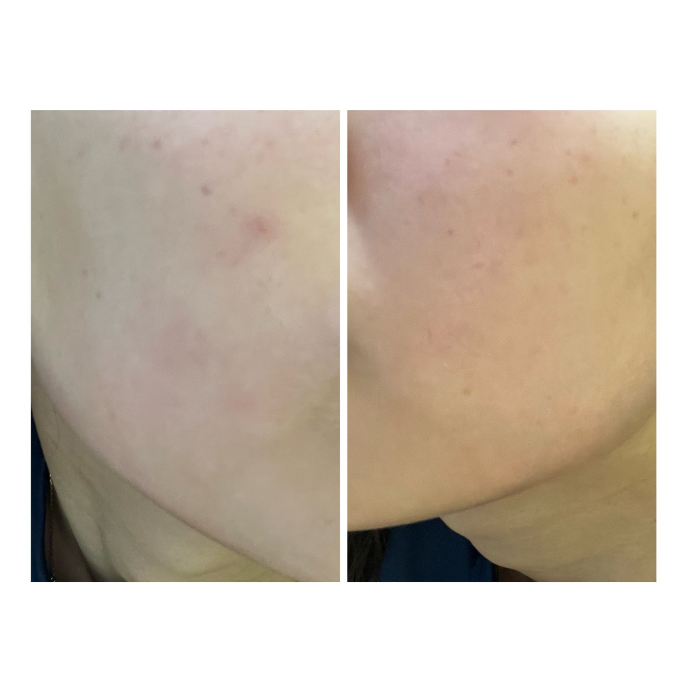 ぽむ on LIPS 「2023.9.13皮膚科に受診 エピデュオとヘパリン処方1枚目..」(5枚目)