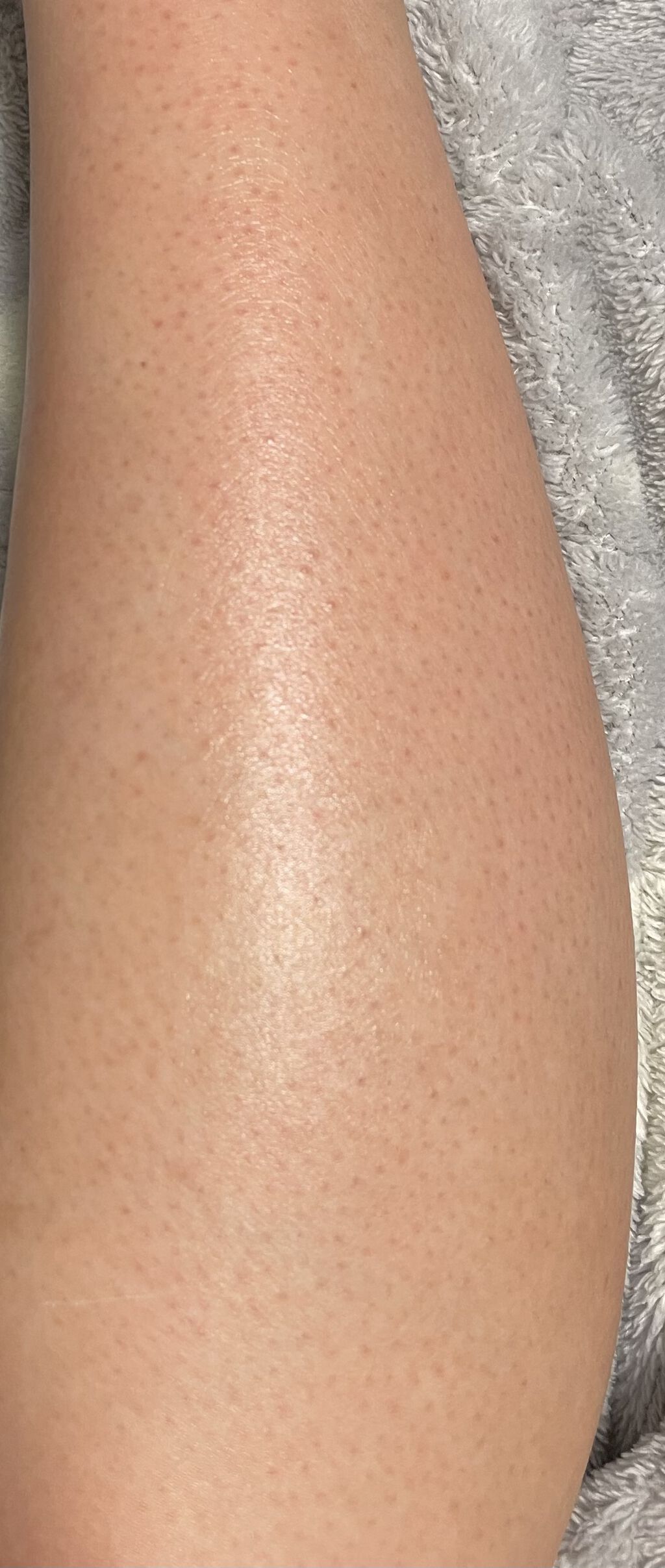 ケアノキュア（医薬品）/小林製薬/その他を使ったクチコミ（2枚目）