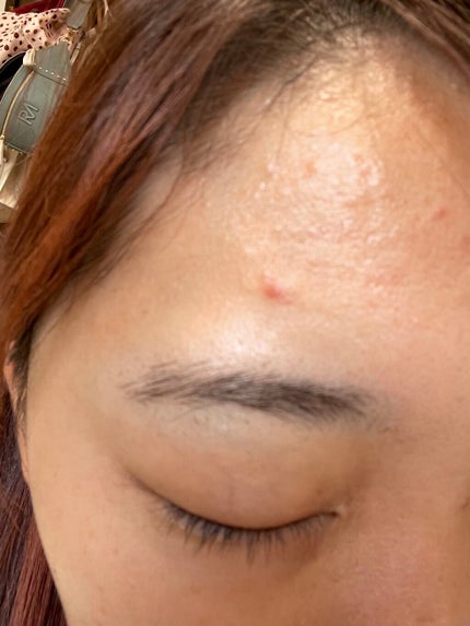 たそ on LIPS 「⚠️閲覧注意⚠️流行りのダーマペン4を施術しに行きます!(とい..」(5枚目)