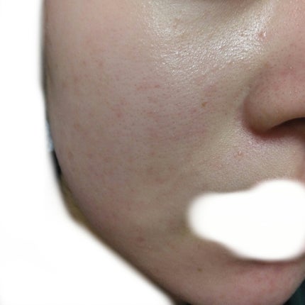 MAYBELLINE NEW YORK フィットミー リキッドファンデーション Rのクチコミ「小さいニキビ跡とかは隠れるけど赤みが目立つ部分とかはあまり隠れないくらいのカバー力です!星で表.....」(3枚目)