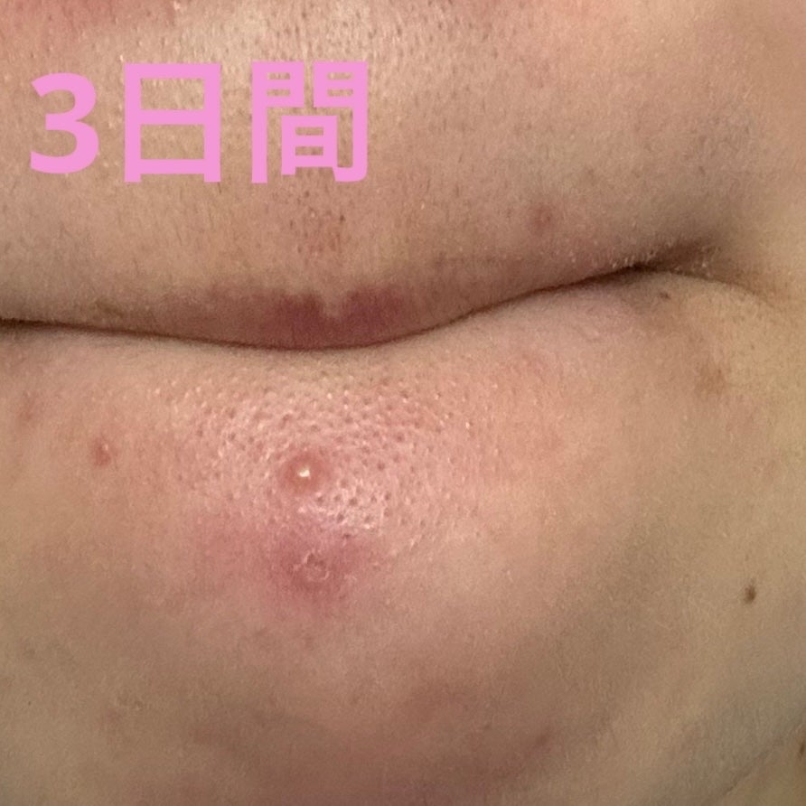 プロCICA クリアスポットパッチ/VT/その他スキンケアを使ったクチコミ(8枚目)