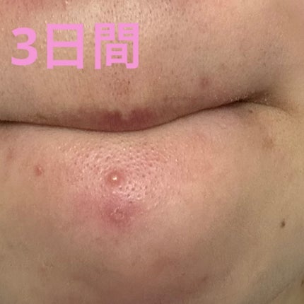 プロCICA クリアスポットパッチ/VT/その他スキンケアを使ったクチコミ(8枚目)