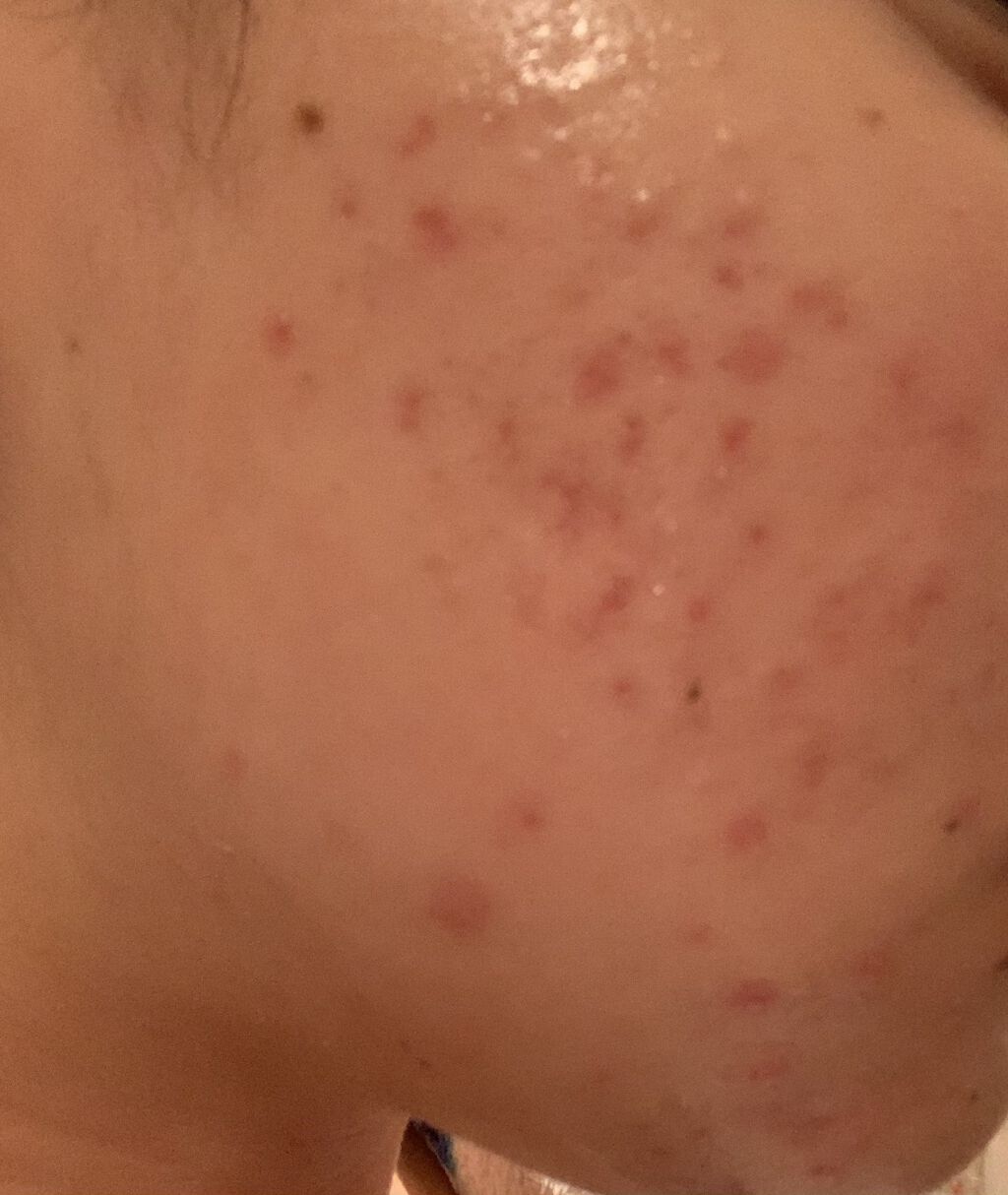 ベピオゲル/マルホ株式会社/その他を使ったクチコミ（2枚目）