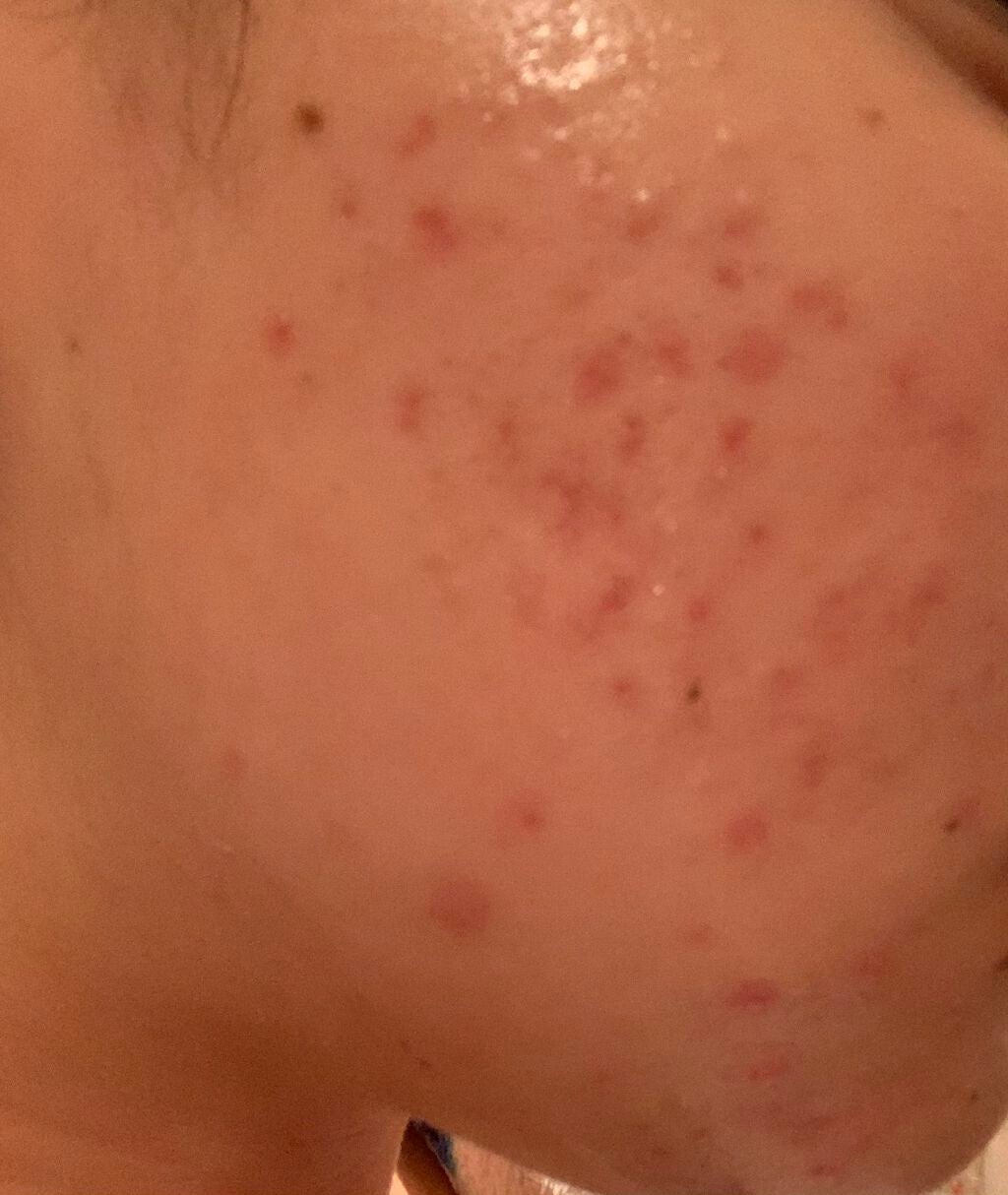 とろり on LIPS 「あけましておめでとうございます!!ニキビに年越しを許可した覚え..」(2枚目)