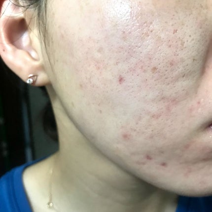 ティーツリーケア ソリューション エッセンシャルマスクEX/MEDIHEAL/シートマスク・パックを使ったクチコミ(1枚目)