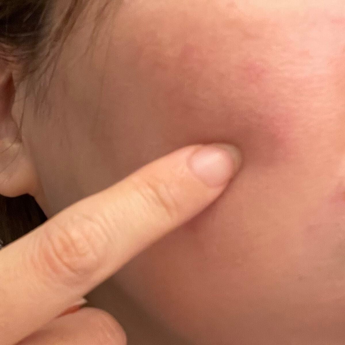 薬用ニキビケア スポッツクリーム/アクネスラボ/フェイスクリームを使ったクチコミ(2枚目)