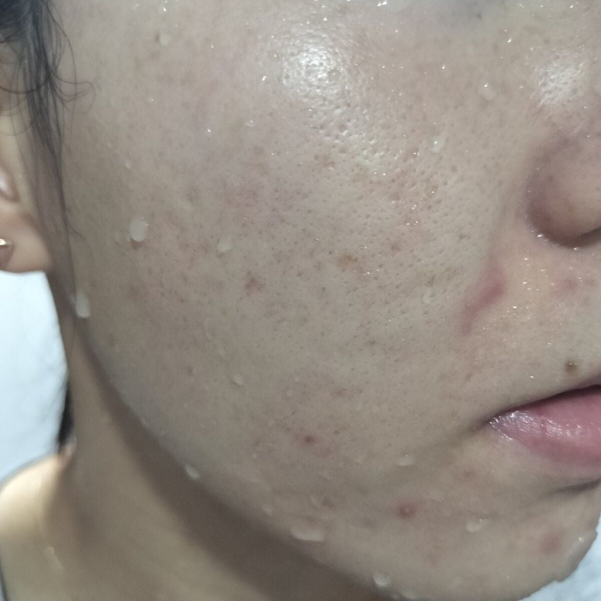 miina@汚肌工事録⚠️ on LIPS 「11/2の#汚肌工事録鼻の下もあれました…つらたん#毎日運動腹..」(1枚目)