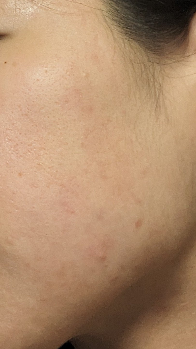 そこのお姉さん、美肌コスメ教えてくれよォ on LIPS 「2枚め激汚肌、3枚め最近の汚肌。どちらもnofilterでお送..」(3枚目)