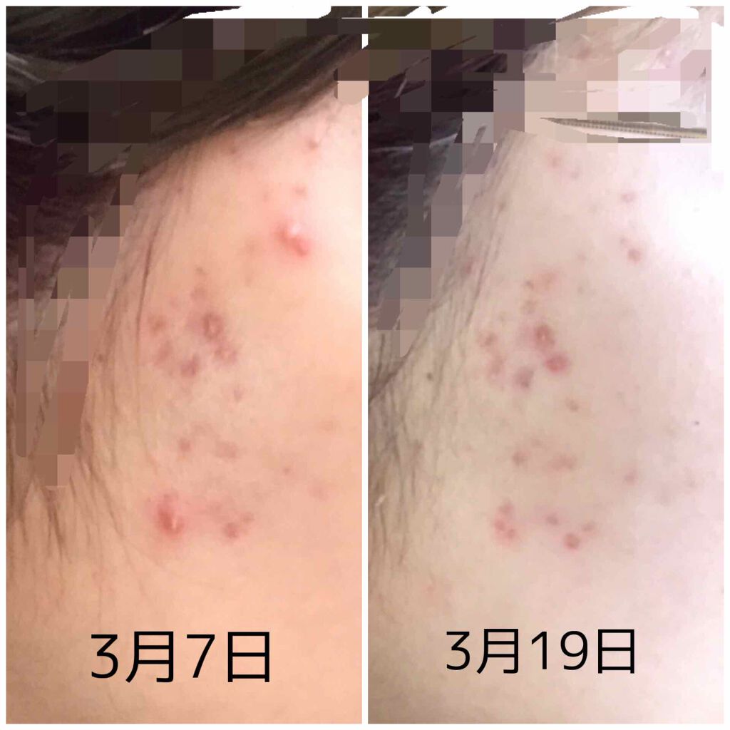 A アクネフォーム/NOV/洗顔フォームを使ったクチコミ（2枚目）