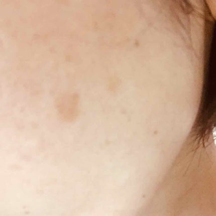 業務用ハイドロキノン/旭研究所/その他スキンケアを使ったクチコミ(2枚目)