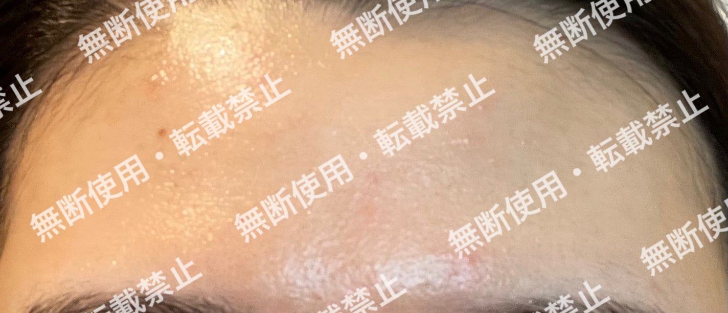 colorful_perfume_r39m on LIPS 「まずこれを初期の肌の状態写真とします。※自分的に肌が1番汚く見..」(6枚目)