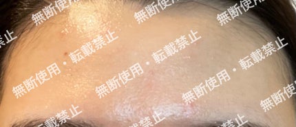 colorful_perfume_r39m on LIPS 「まずこれを初期の肌の状態写真とします。※自分的に肌が1番汚く見..」(6枚目)