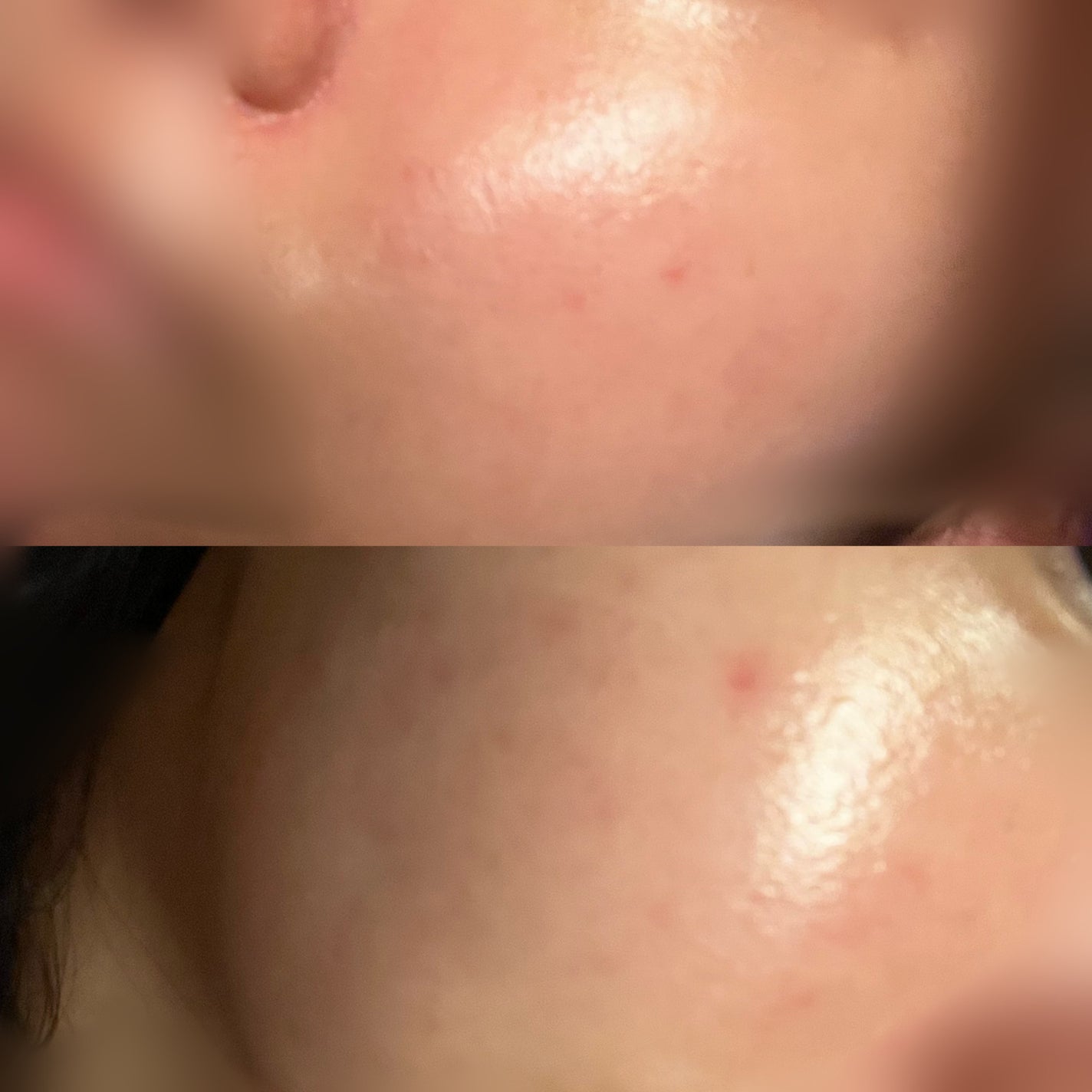 レモン on LIPS 「写真あります⚠️ニキビ撲滅する薬、イソトロインって知ってますか..」(3枚目)