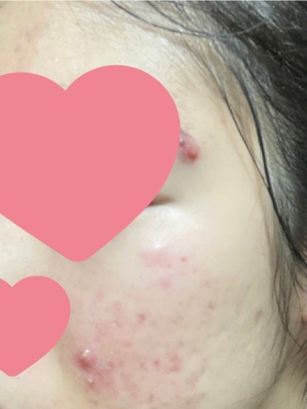 シミ・ソバカス予防ケア 乳液/キュレル/乳液を使ったクチコミ(2枚目)