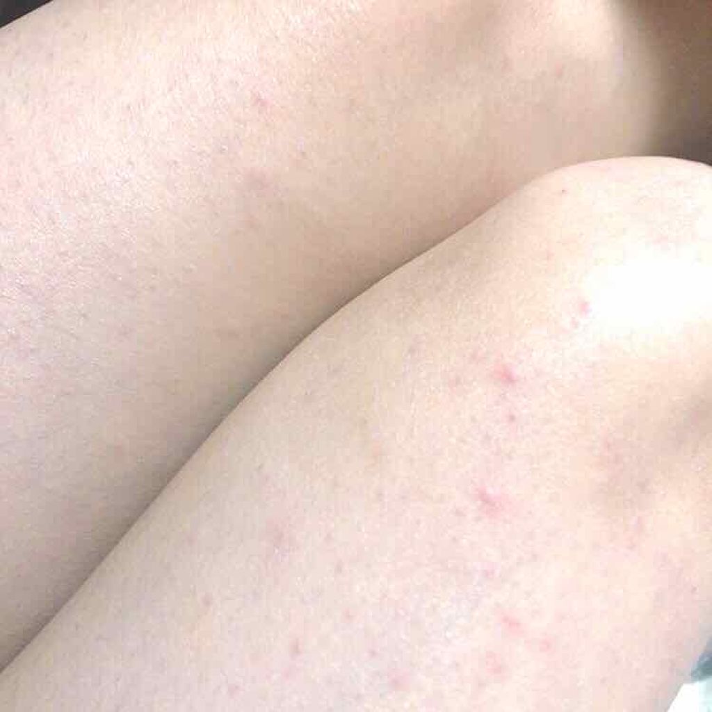 オロナインＨ軟膏 (医薬品)/オロナイン/その他を使ったクチコミ（3枚目）