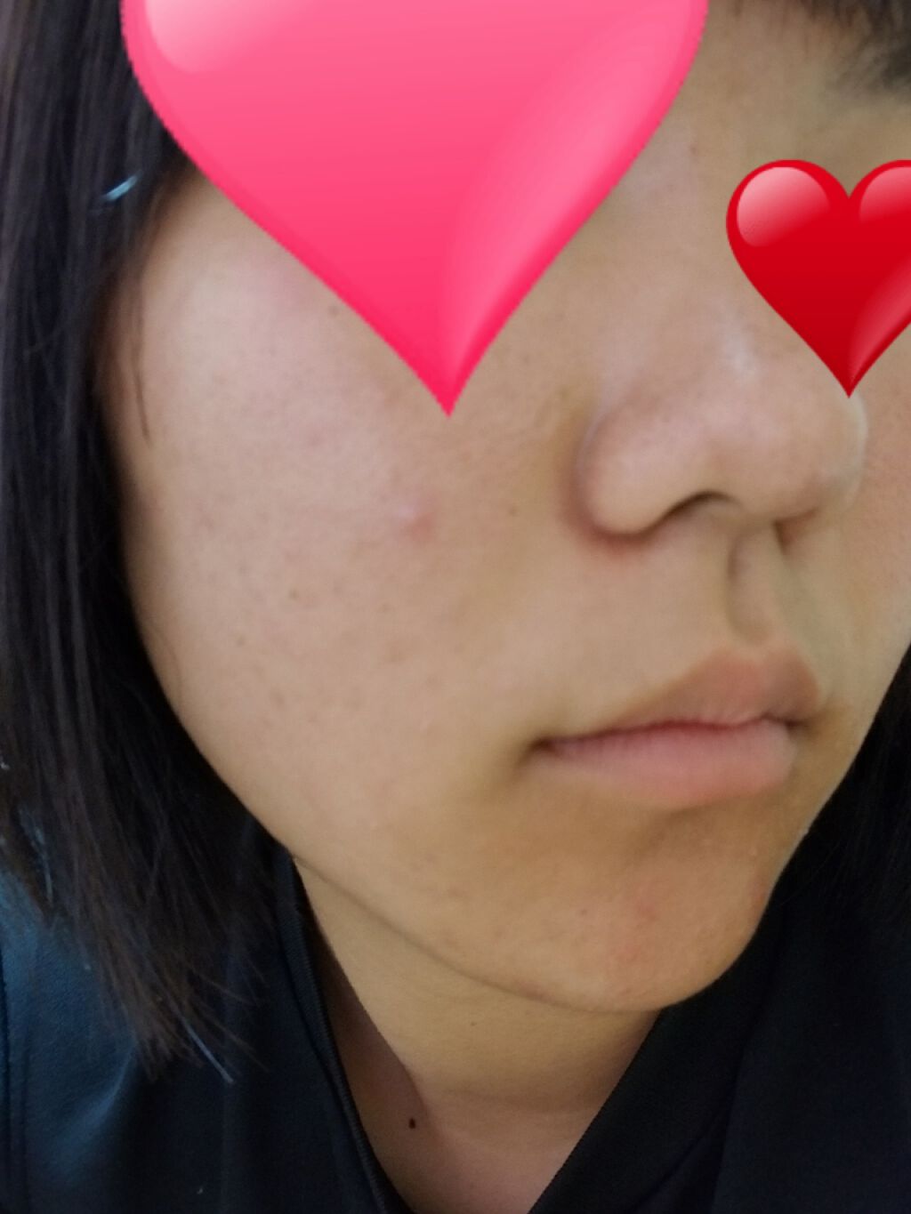 あいはな日記🌸自分磨きがんばります!!! on LIPS 「小学生からニキビが酷くてだいぶ減った方なんですが、ニキビ跡とか..」(1枚目)