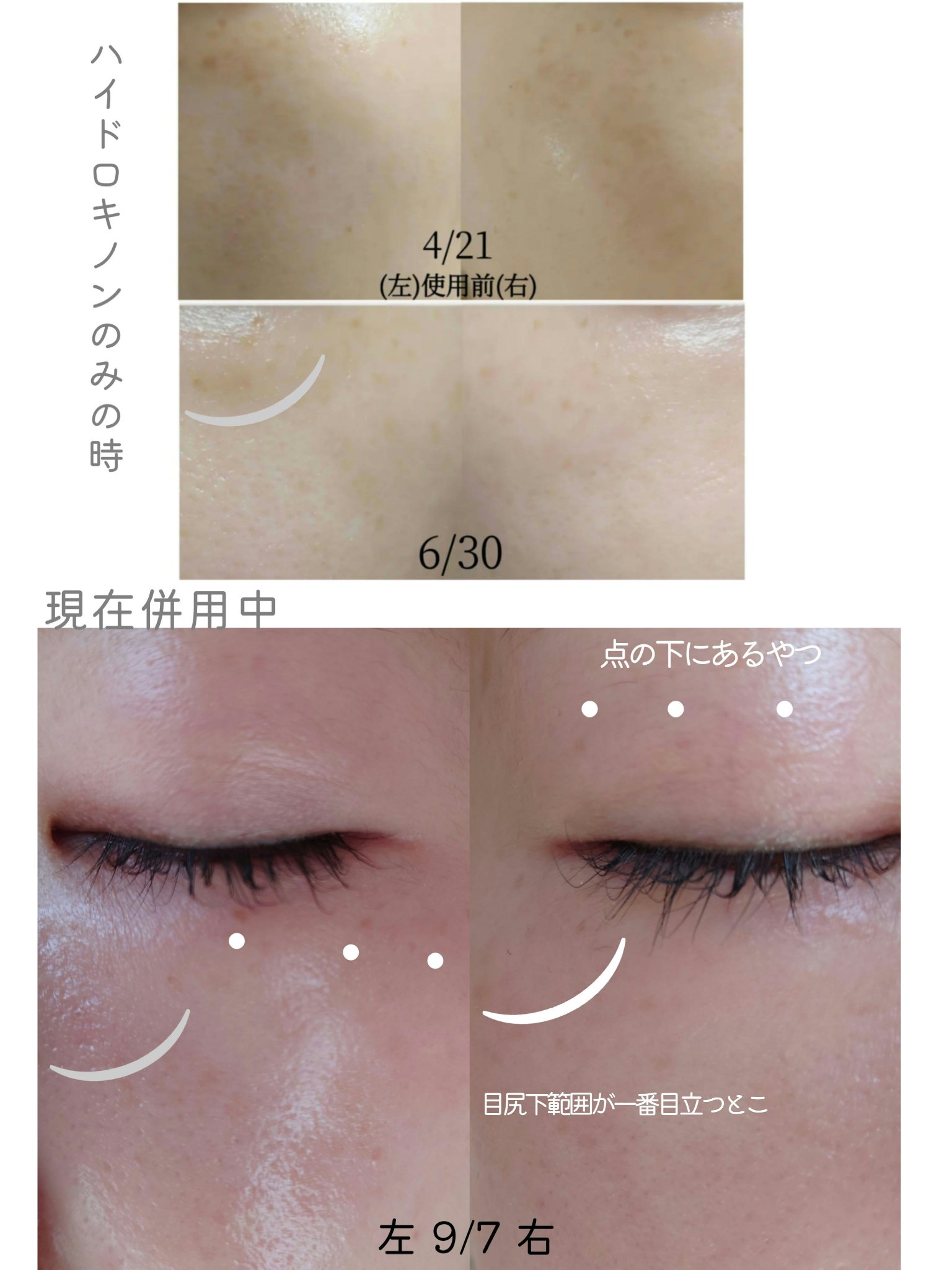 トレチノインジェル/A-Ret/美容液を使ったクチコミ（3枚目）