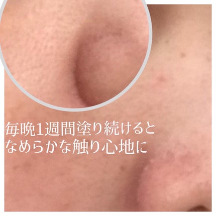 ダーマセプトRX AZAセラム/ダーマセプトRX/美容液を使ったクチコミ(4枚目)