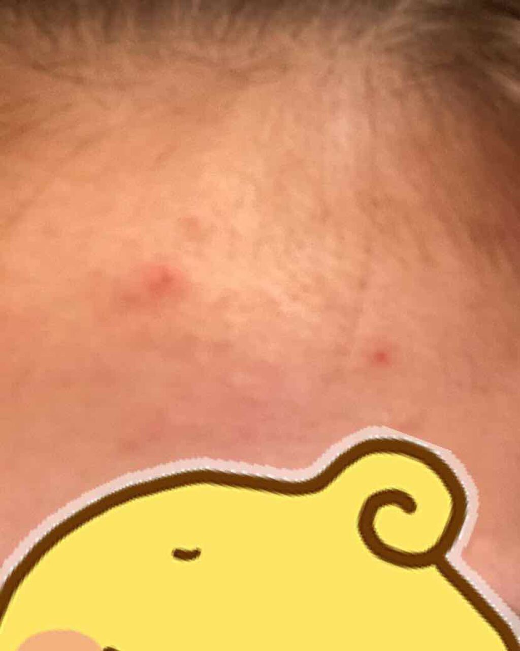 ペアアクネクリームW(医薬品)/ペア/その他を使ったクチコミ(2枚目)