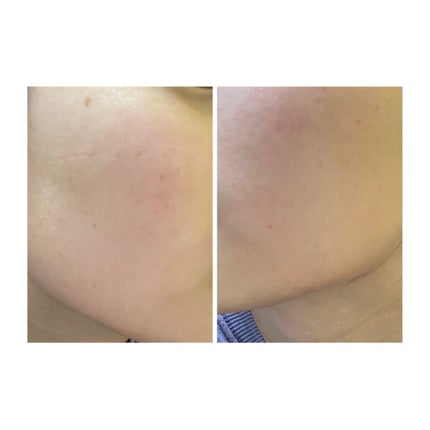 ぽむ on LIPS 「2023.9.13皮膚科に受診 エピデュオとヘパリン処方1枚目..」(5枚目)