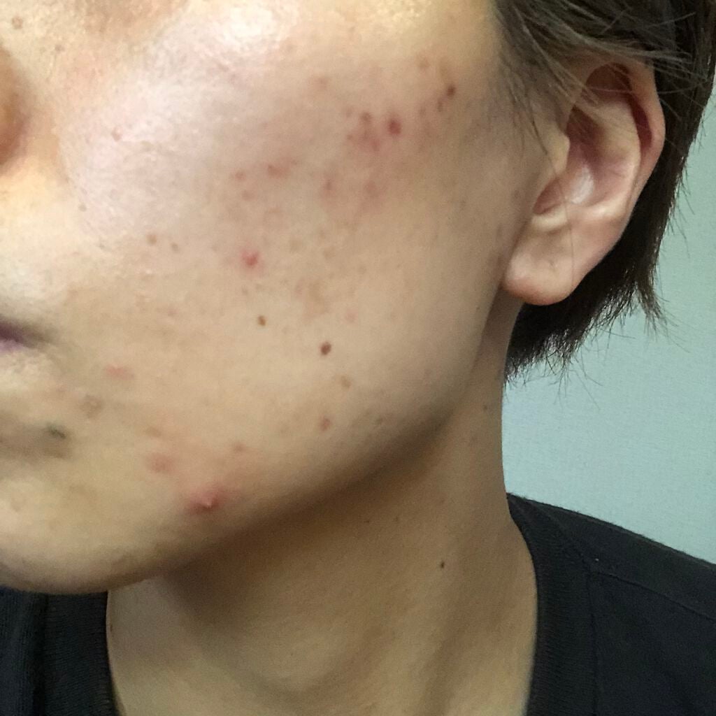 りんにゃ~フォロバ100🙆🏼♀️~🔰 on LIPS 「荒れ荒れ。鏡で見るとそこまで無い気がしたんだけど写真で見ると赤..」(2枚目)