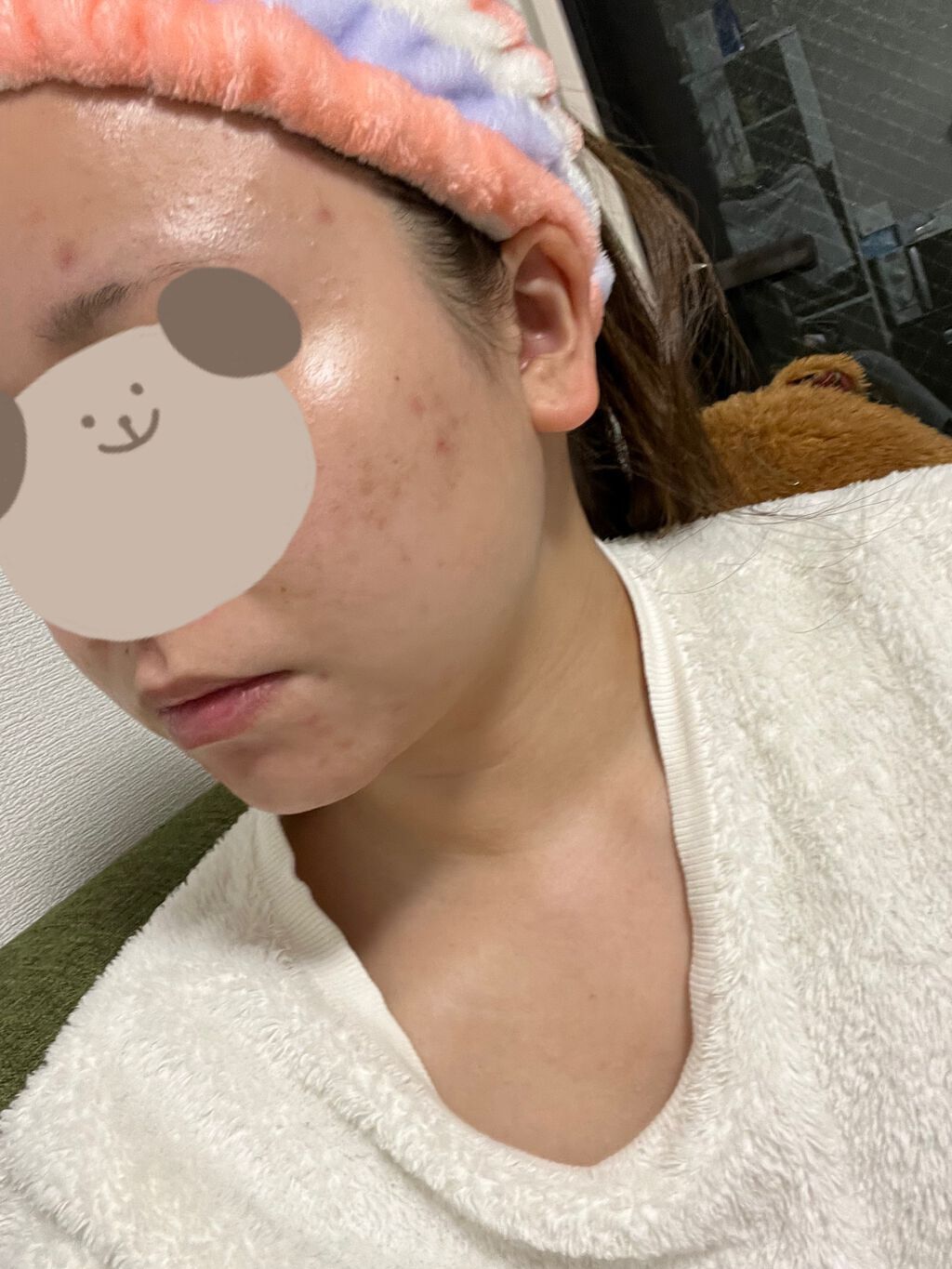 ペアアクネクリームW(医薬品)/ペア/その他を使ったクチコミ（3枚目）