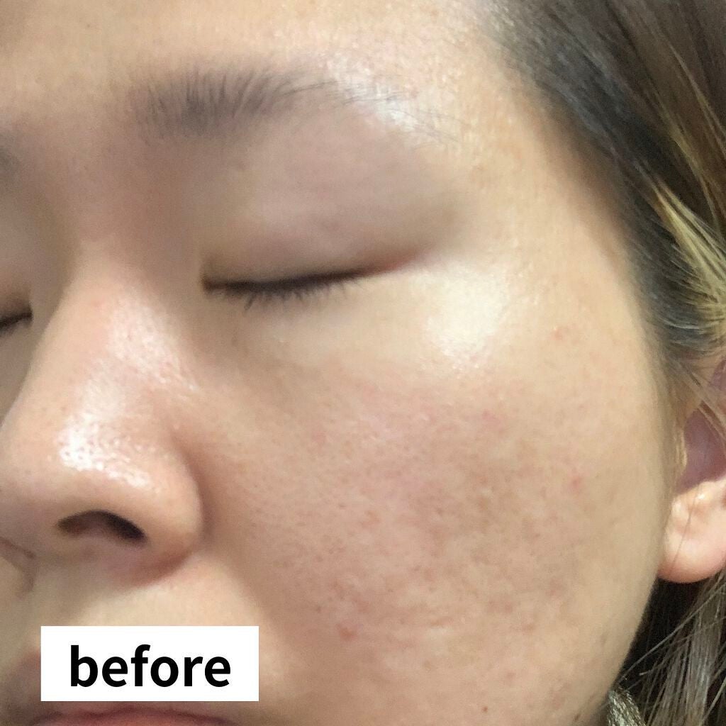 プロヒアルショット モイスチャーピーリングパッド/Dermatory/トナーパッドを使ったクチコミ(7枚目)