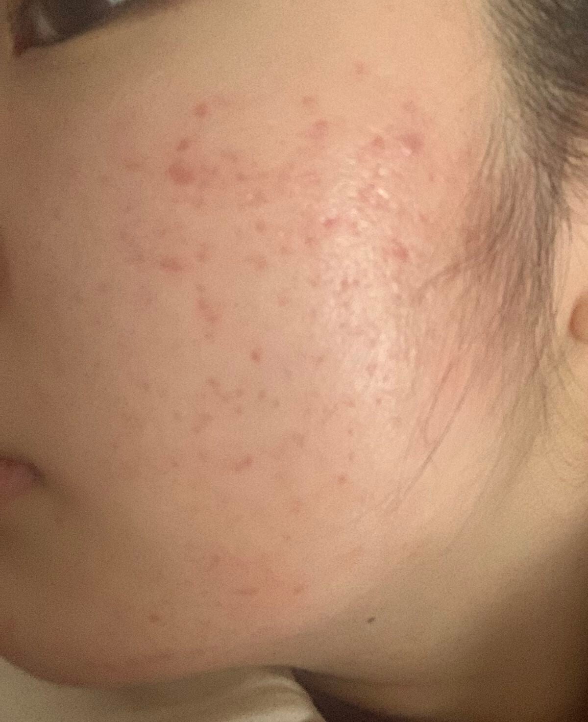 ニキビ跡消えろ on LIPS 「ニキビ跡日記11月5日よくなってるのだ。#ベピオゲル#ニキビ#..」(2枚目)