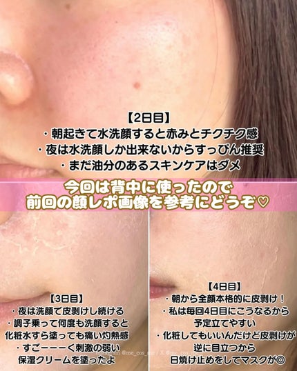 ダーマスキンピーリング/BQCELL/その他キットセットを使ったクチコミ(5枚目)