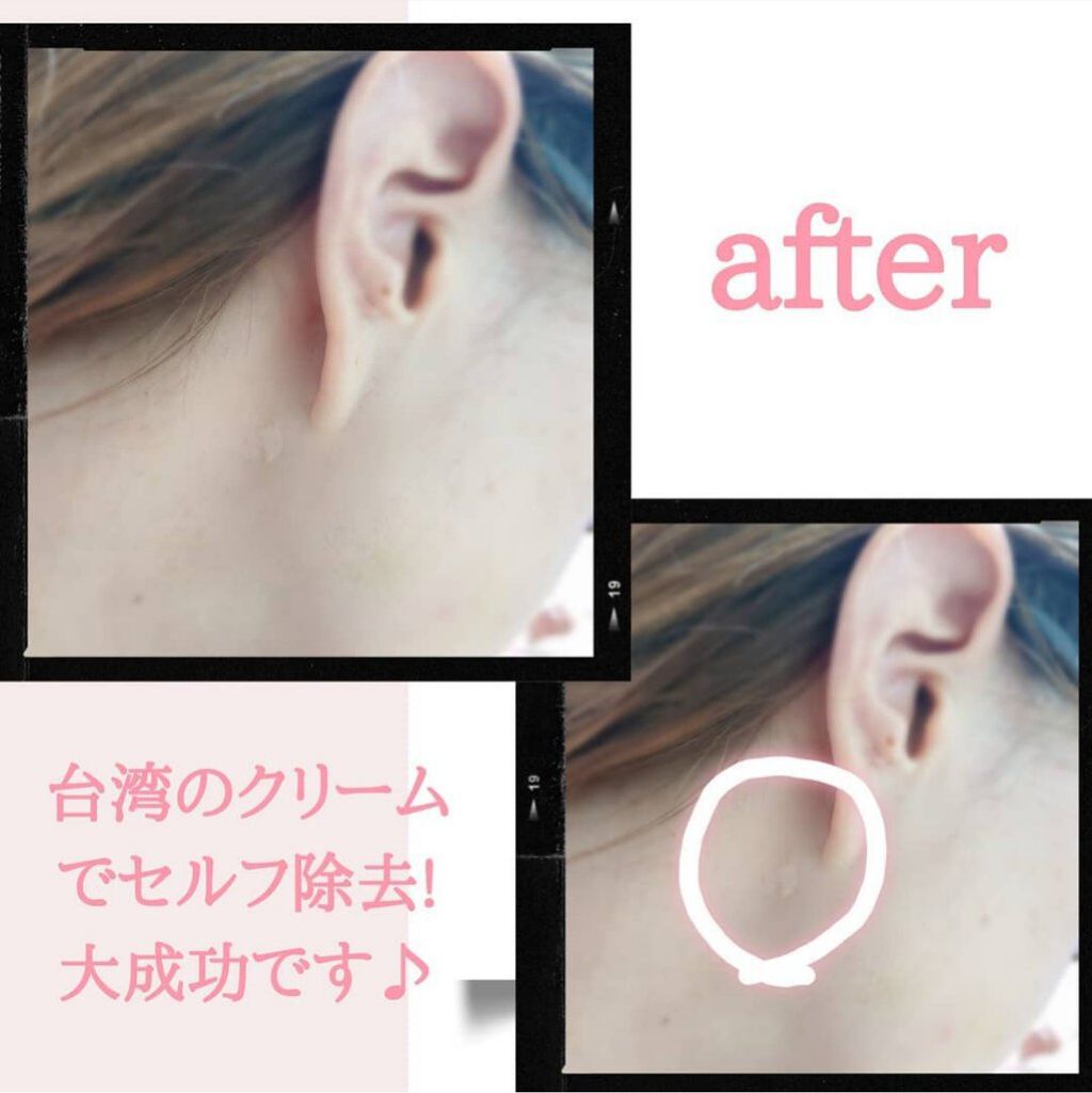 キズパワーパッド/バンドエイド/その他を使ったクチコミ（2枚目）