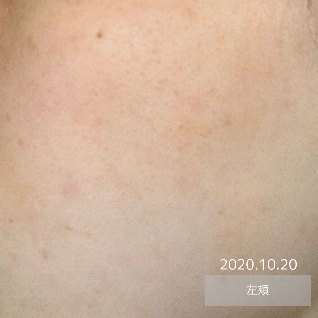 オードムーゲ 薬用ローション(ふきとり化粧水)/オードムーゲ/拭き取り化粧水を使ったクチコミ(2枚目)