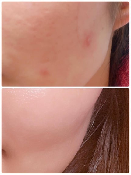 スキンピールバー ハイドロキノール/サンソリット/洗顔石鹸を使ったクチコミ(1枚目)