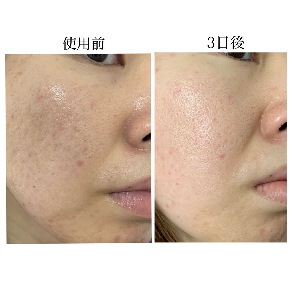 生VC美白美容液/Yunth/美容液を使ったクチコミ(7枚目)