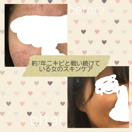 にきびの治療薬 カラミラアクネ軟膏(医薬品)/グレンツ メディカル/その他を使ったクチコミ(1枚目)