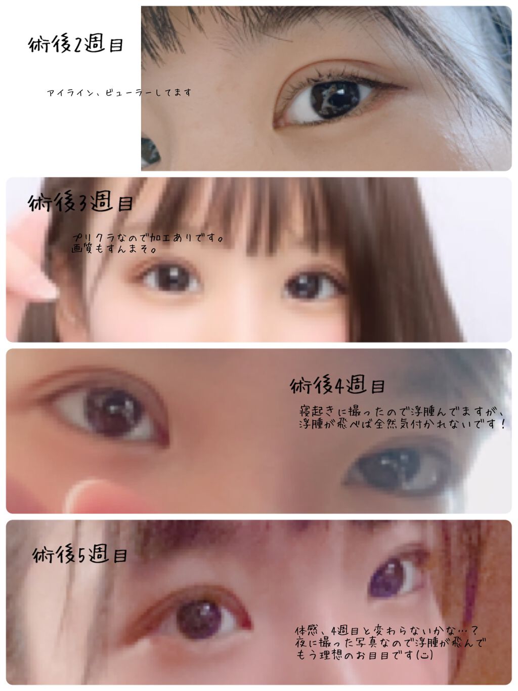 いちご on LIPS 「二重切開法をして、6週に入りました!術後2週間くらいは瞼の感覚..」(1枚目)