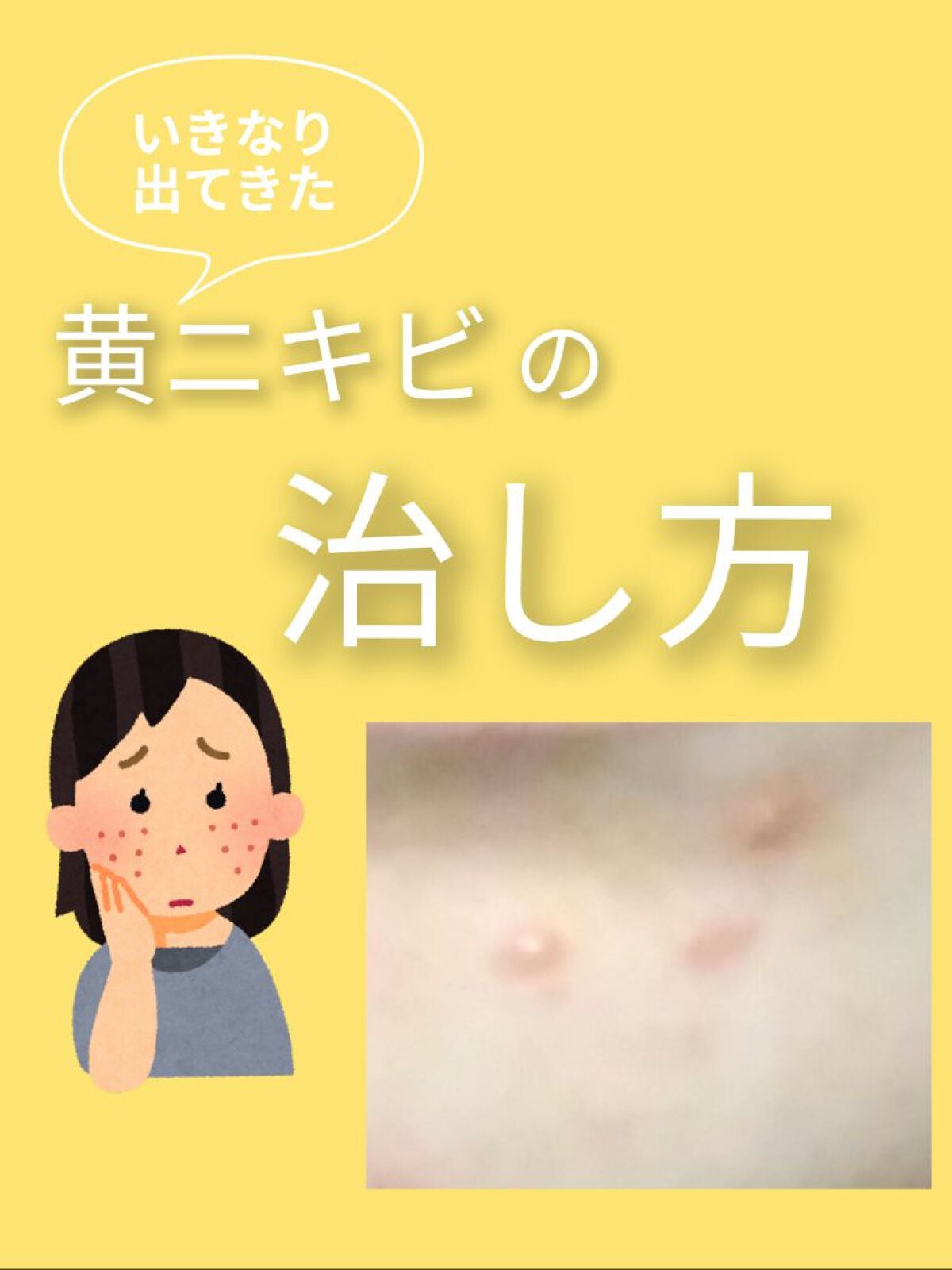 ロゼット洗顔パスタ アクネクリア/ロゼット/洗顔フォームを使ったクチコミ(1枚目)