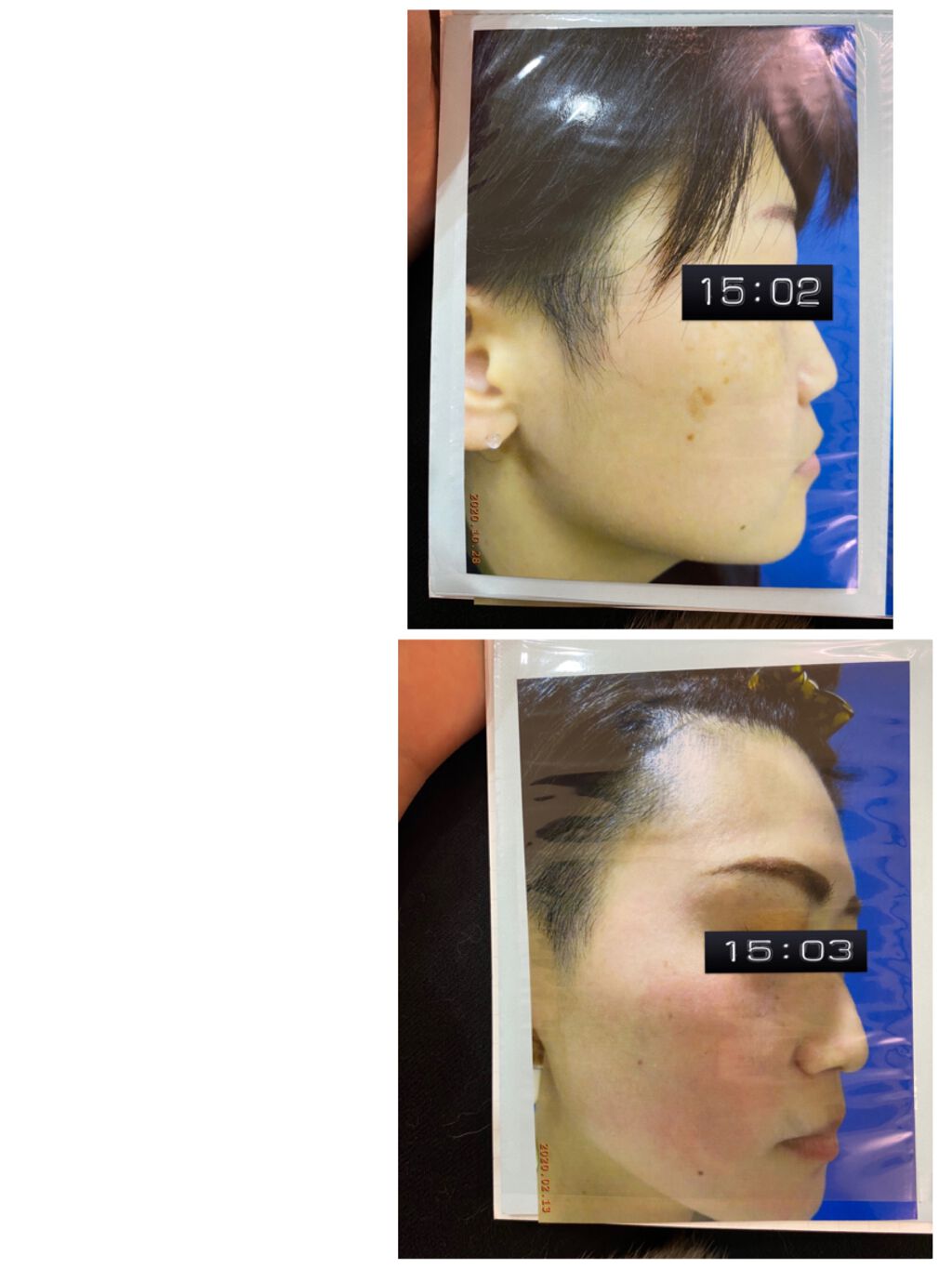 ☆ロードスター☆ on LIPS 「はい!3ヶ月の治療期間終了しました❤️あーひどい皮むけたえた甲..」(3枚目)