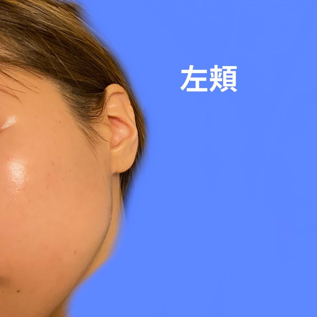 SR on LIPS 「ニキビ記録〜2021/11/14〜左頬は赤みのある炎症、ニキビ..」(3枚目)