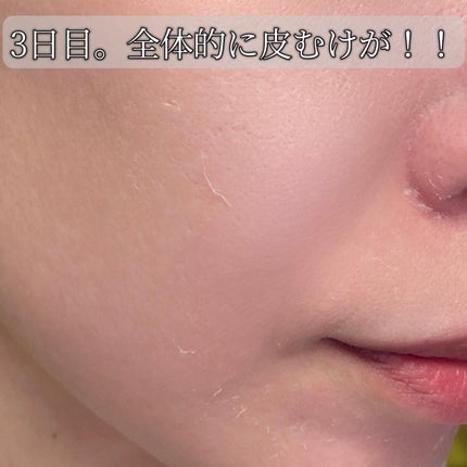 ダーマスキンピーリング/BQCELL/その他キットセットを使ったクチコミ(6枚目)