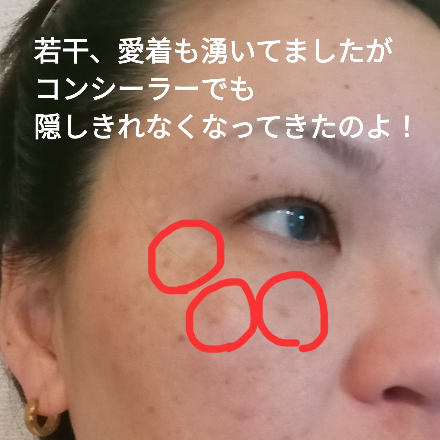 ビヨンセ奥二重向上委員長🥸LIPSパートナー🥳 on LIPS 「湘南美容クリニックでシミ取りレーザーしてきたよ!なんと3つで7..」(3枚目)