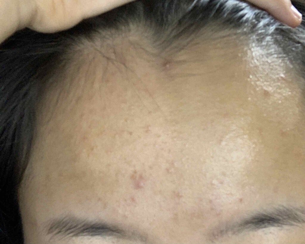 薬用ふわふわな泡洗顔/メンソレータム アクネス/泡洗顔を使ったクチコミ(1枚目)