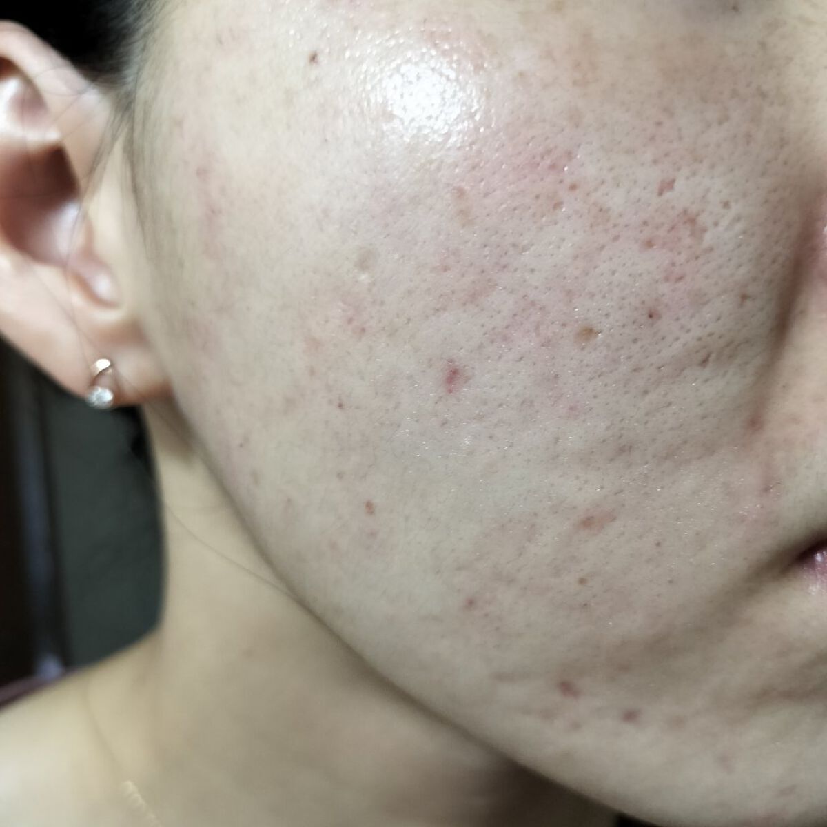 Azelaic Acid Suspension 10 The Ordinaryを使った口コミ 9 14の 汚肌工事録いつも見守ってくださ By Miina 汚肌工事録 混合肌 代後半 Lips
