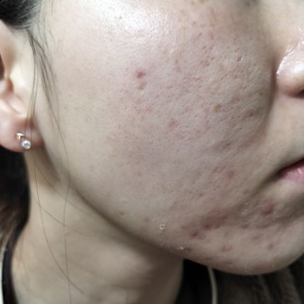 スキンピールバー ティートゥリー/サンソリット/洗顔石鹸を使ったクチコミ(1枚目)