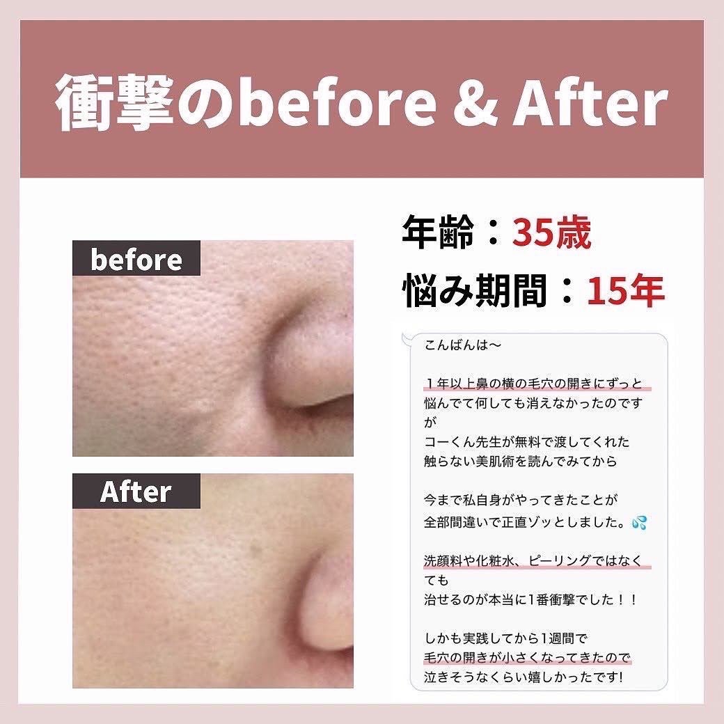 あなたの肌に合ったスキンケア💐コーくん先生 on LIPS 「【驚愕】9割が知らない毛穴を1日で消す方法🤫...あなたの毛穴..」(2枚目)