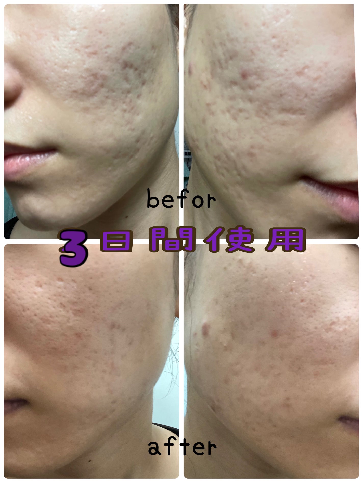 AGE-R ブースタープロ|MEDICUBEの効果に関する口コミ - 【使っ AGE-R ブースタープロ|MEDICUBEの効果に関する口コミ - 【使っ