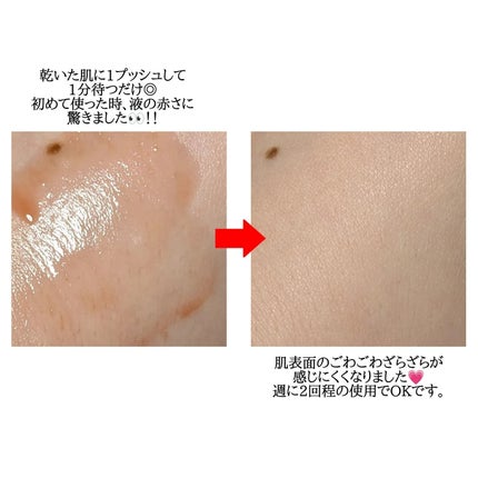 レッドアクネ ボディピーリングショット/MEDICUBE/ピーリングを使ったクチコミ(4枚目)