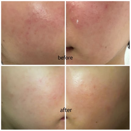 ピグメントビオ ブライトニング ビタミンC フェイスセラム アンチダークスポット/ビオデルマ/美容液を使ったクチコミ(2枚目)