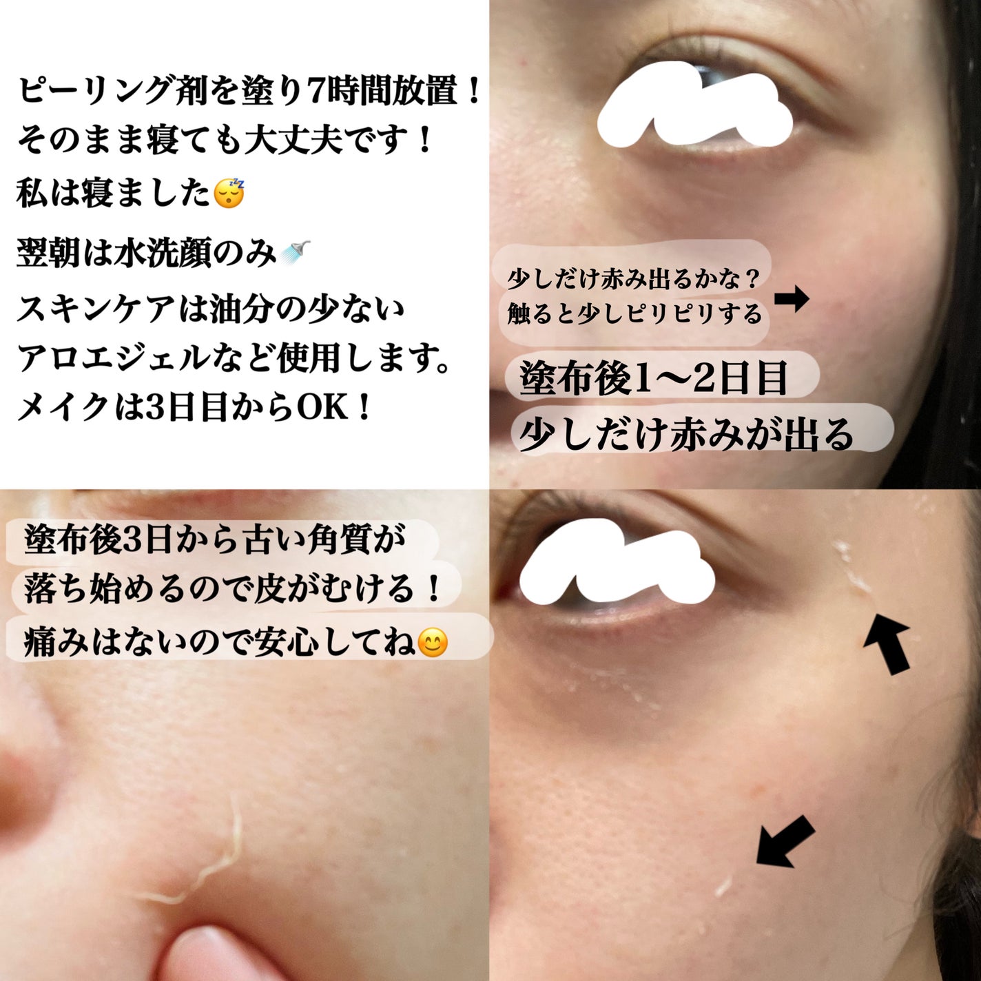 ダーマスキンピーリング|BQCELLの使い方を徹底解説 - #提供 ダーマスキンピーリング|BQCELLの使い方を徹底解説 - #提供